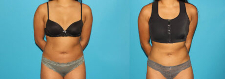 Liposuction case #5890