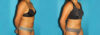 Liposuction case #5890 slider thumbnail