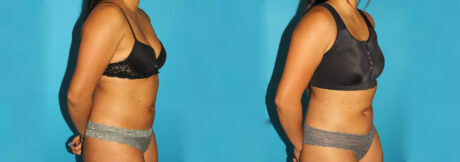 Liposuction case #5890