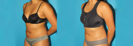 Liposuction case #5890