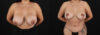 Revision Breast Surgery case #256274 slider thumbnail