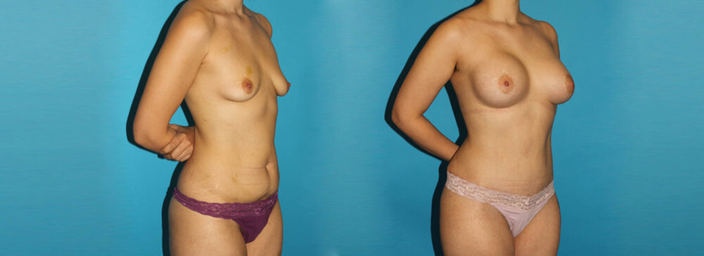 Post Bariatric Surgery (Massive Weight Loss) case #6777