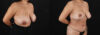 Revision Breast Surgery case #256274 slider thumbnail