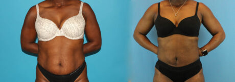 Liposuction case #5891