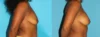 Fat Grafting to the Breast case #256147 slider thumbnail