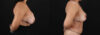 Revision Breast Surgery case #256274 slider thumbnail