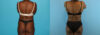 Liposuction case #5891 slider thumbnail