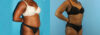 Liposuction case #5891 slider thumbnail