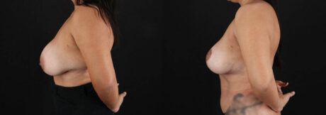 Revision Breast Surgery case #256274