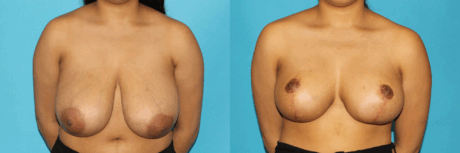 Breast Reduction case #7962