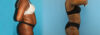 Liposuction case #5891 slider thumbnail