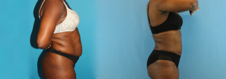 Liposuction case #5891