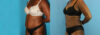 Liposuction case #5891 slider thumbnail
