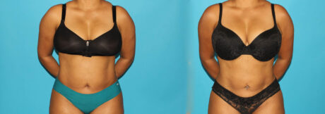 Liposuction case #5894