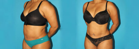 Liposuction case #5894