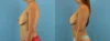 Fat Grafting to the Breast case #256167 slider thumbnail