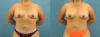Fat Grafting to the Breast case #256201 slider thumbnail