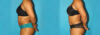 Liposuction case #5894 slider thumbnail