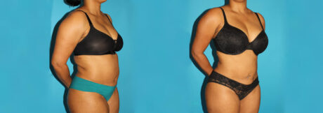 Liposuction case #5894