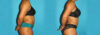 Liposuction case #5894 slider thumbnail