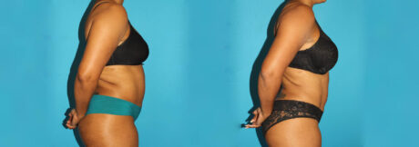 Liposuction case #5894