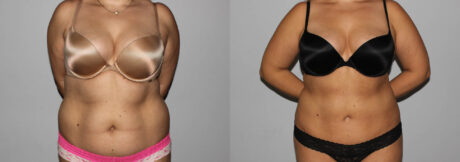 Liposuction case #5828