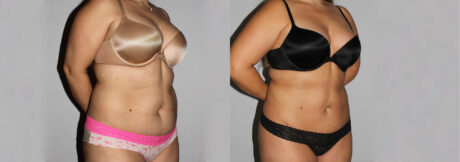 Liposuction case #5828