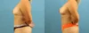 Fat Grafting to the Breast case #256201 slider thumbnail