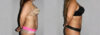 Liposuction case #5828 slider thumbnail