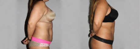 Liposuction case #5828