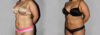 Liposuction case #5828 slider thumbnail