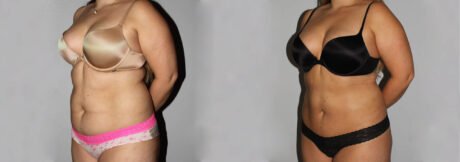 Liposuction case #5828
