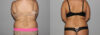 Liposuction case #5828 slider thumbnail