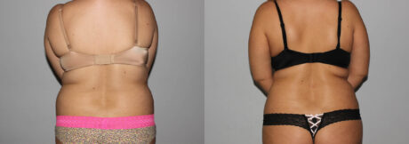 Liposuction case #5828