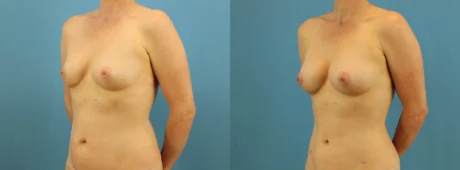 Fat Grafting to the Breast case #256188