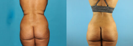 Liposuction case #5892