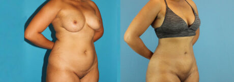 Liposuction case #5892