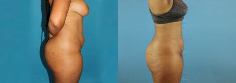 Liposuction case #5892