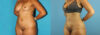 Liposuction case #5892 slider thumbnail