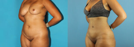 Liposuction case #5892