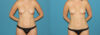 Liposuction case #5961 slider thumbnail