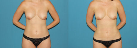 Liposuction case #5961
