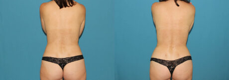 Liposuction case #5961