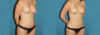 Liposuction case #5961 slider thumbnail
