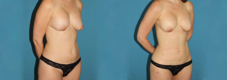 Liposuction case #5961
