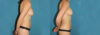Liposuction case #5961 slider thumbnail
