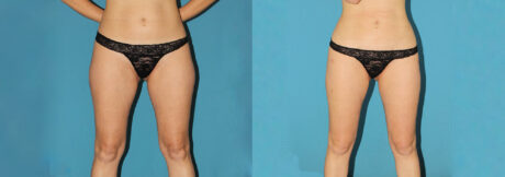 Liposuction case #5961