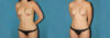 Liposuction case #5961 slider thumbnail