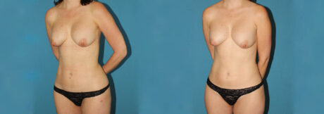 Liposuction case #5961