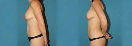 Liposuction case #5961